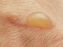 Significato e concetto, Blister - cosa è